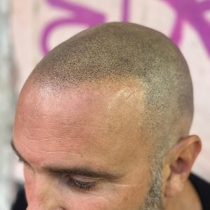 Micropigmentación Capilar