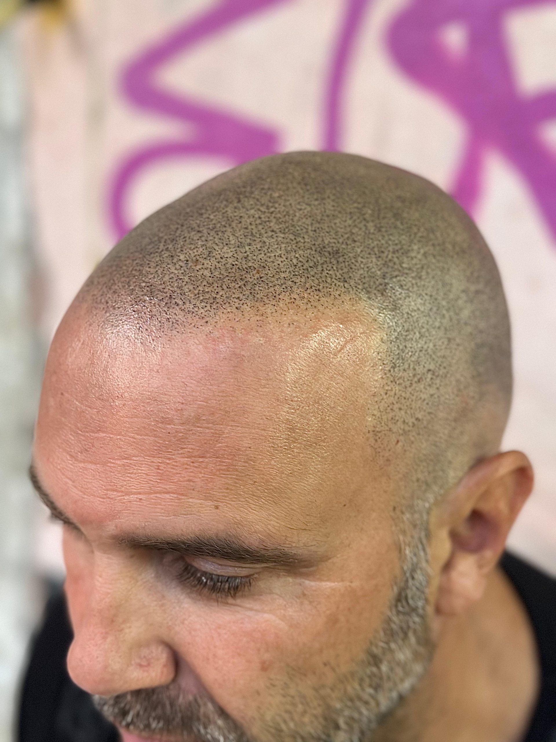 Micropigmentación Capilar