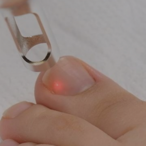 Eliminación láser (Onicomicosis)